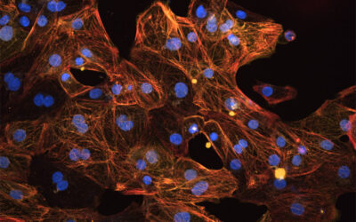 Myofibrillar Myopathy