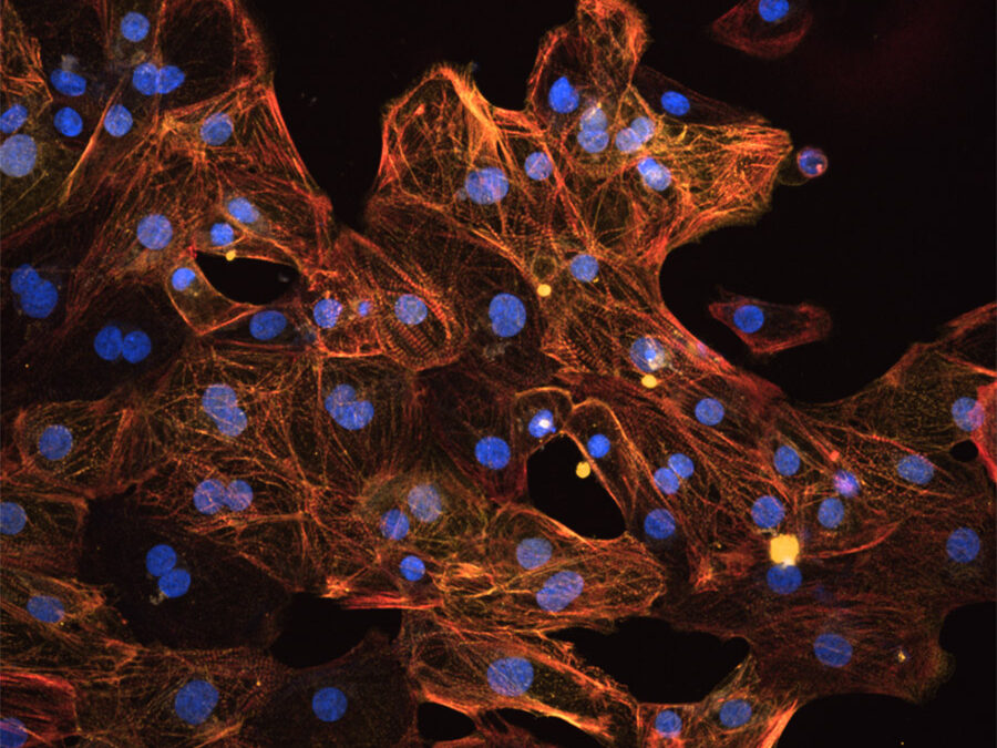 Myofibrillar Myopathy