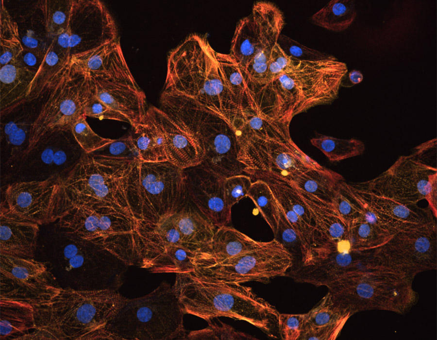 Myofibrillar Myopathy