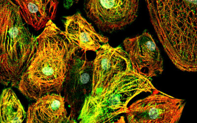 Dilated Cardio Myopathy (DCM)