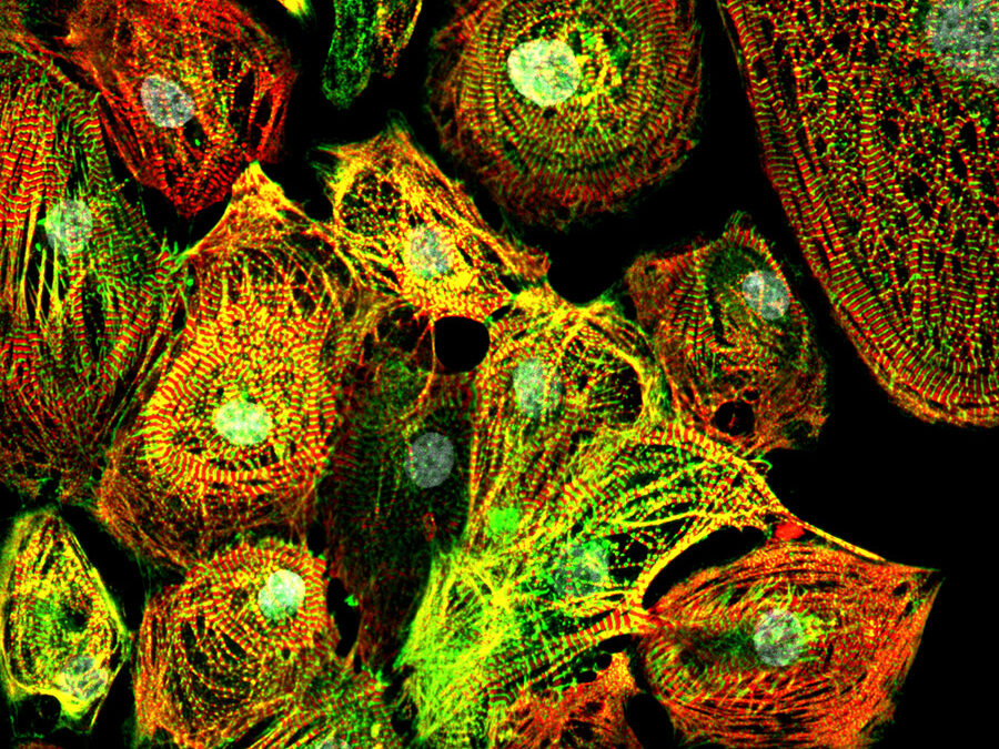 Dilated Cardio Myopathy (DCM)