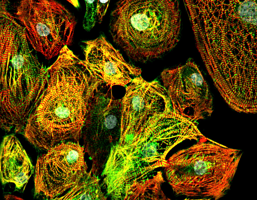 Dilated Cardio Myopathy