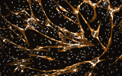 Myotonic Dystrophy Type 1 (MD1)