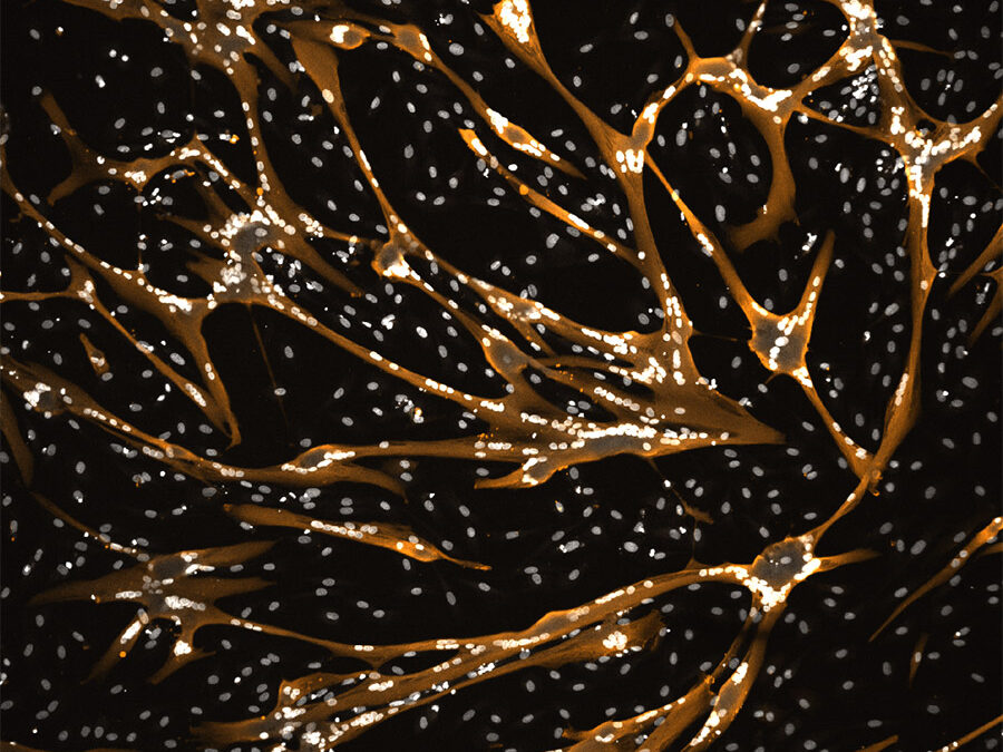 Myotonic Dystrophy Type 1 (MD1)