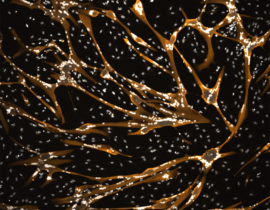 Myotonic Dystrophie Type 1