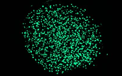 First success for Personalized Functional Profiling (PFP) of gastro-intestinal cancers